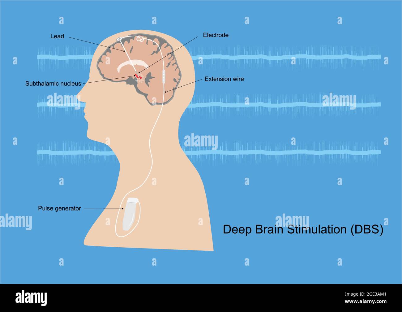 Neuromodulation avec stimulation cérébrale profonde ou DBS au noyau subthalamique pour le traitement de la maladie de Parkinson. Illustration de l'équipement médical et Illustration de Vecteur