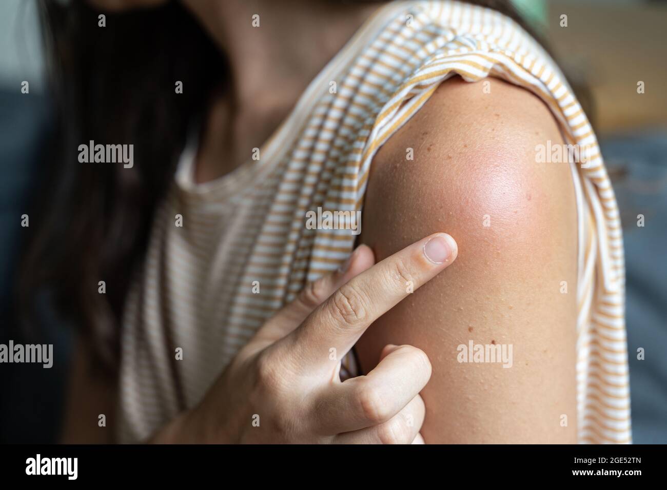 Effet secondaire du vaccin - rougeur et douleur de la peau de l'épaule. Réaction de vaccination Covid-19. La peau de la femme démange et gonfle après la vaccination Banque D'Images