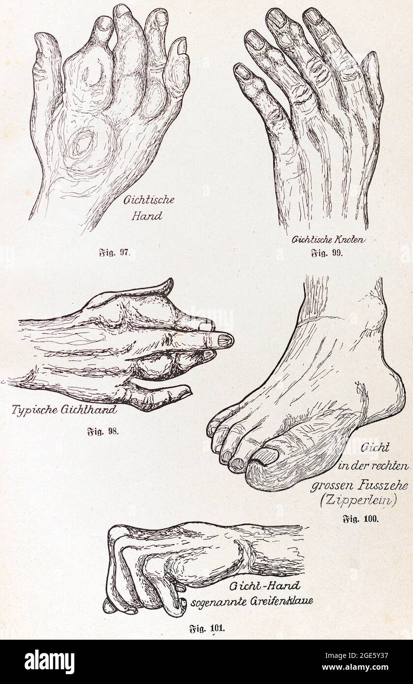 Déformant (défiguration) goutte, Praktischer Hausschatz der Heilkunde, II. Vol., 1930, Heinrich Killinger, Nordhausen Banque D'Images