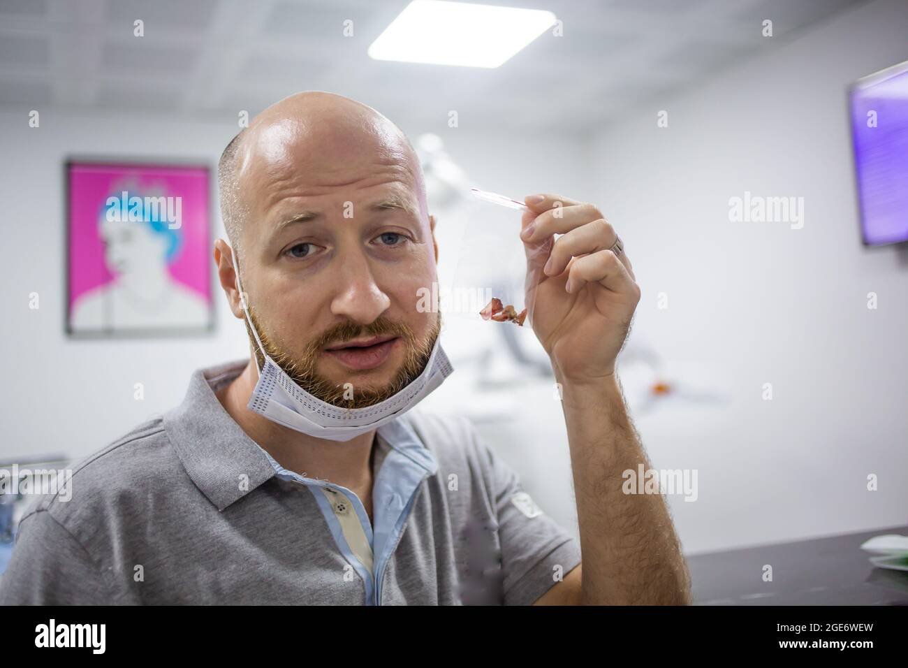 Un homme caucasien montrant ses dents dans la main après une opération d'extraction de dent de sagesse dans un hôpital dentaire. Banque D'Images