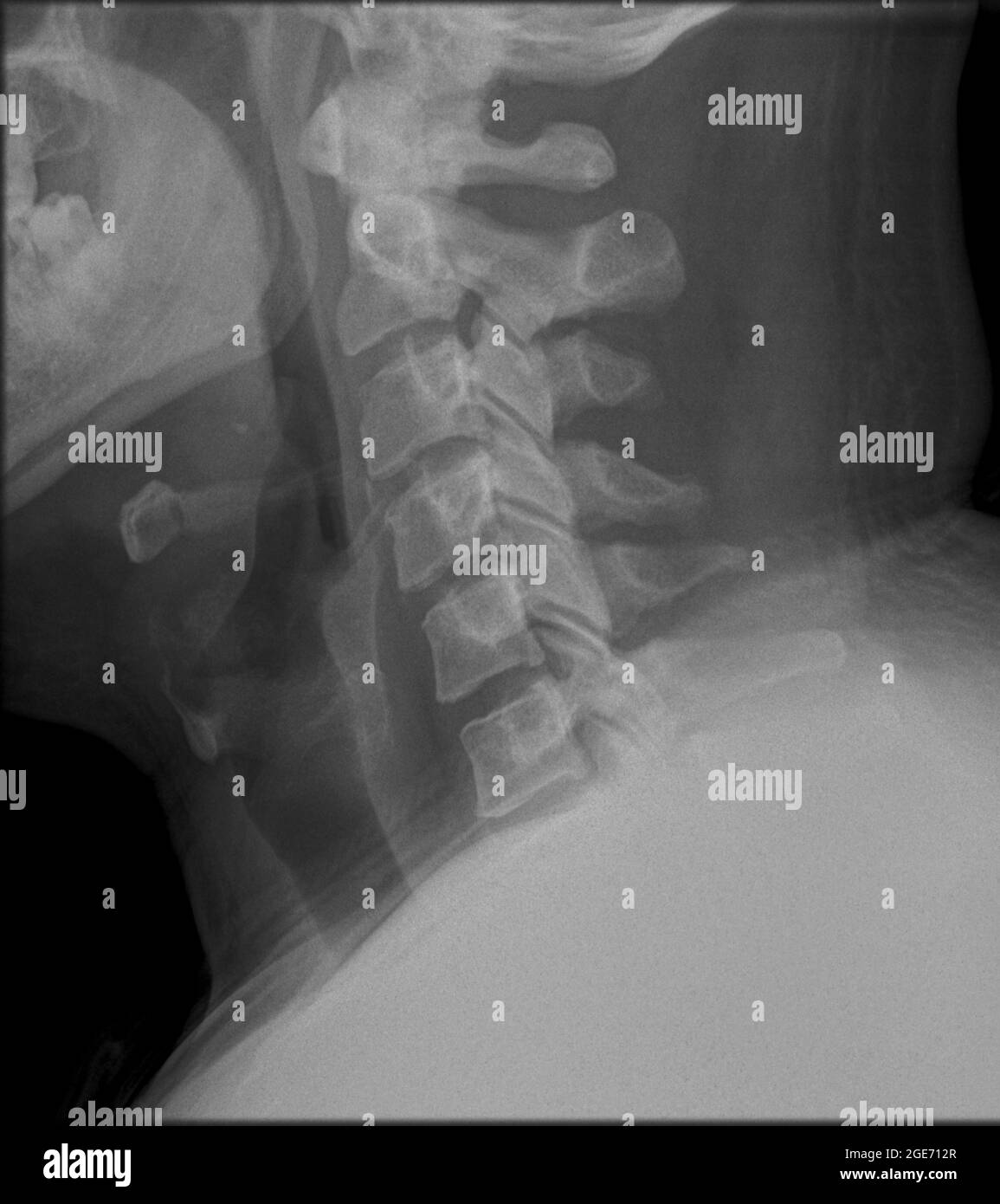 X-ray d'une vue latérale de la colonne cervicale humaine Banque D'Images