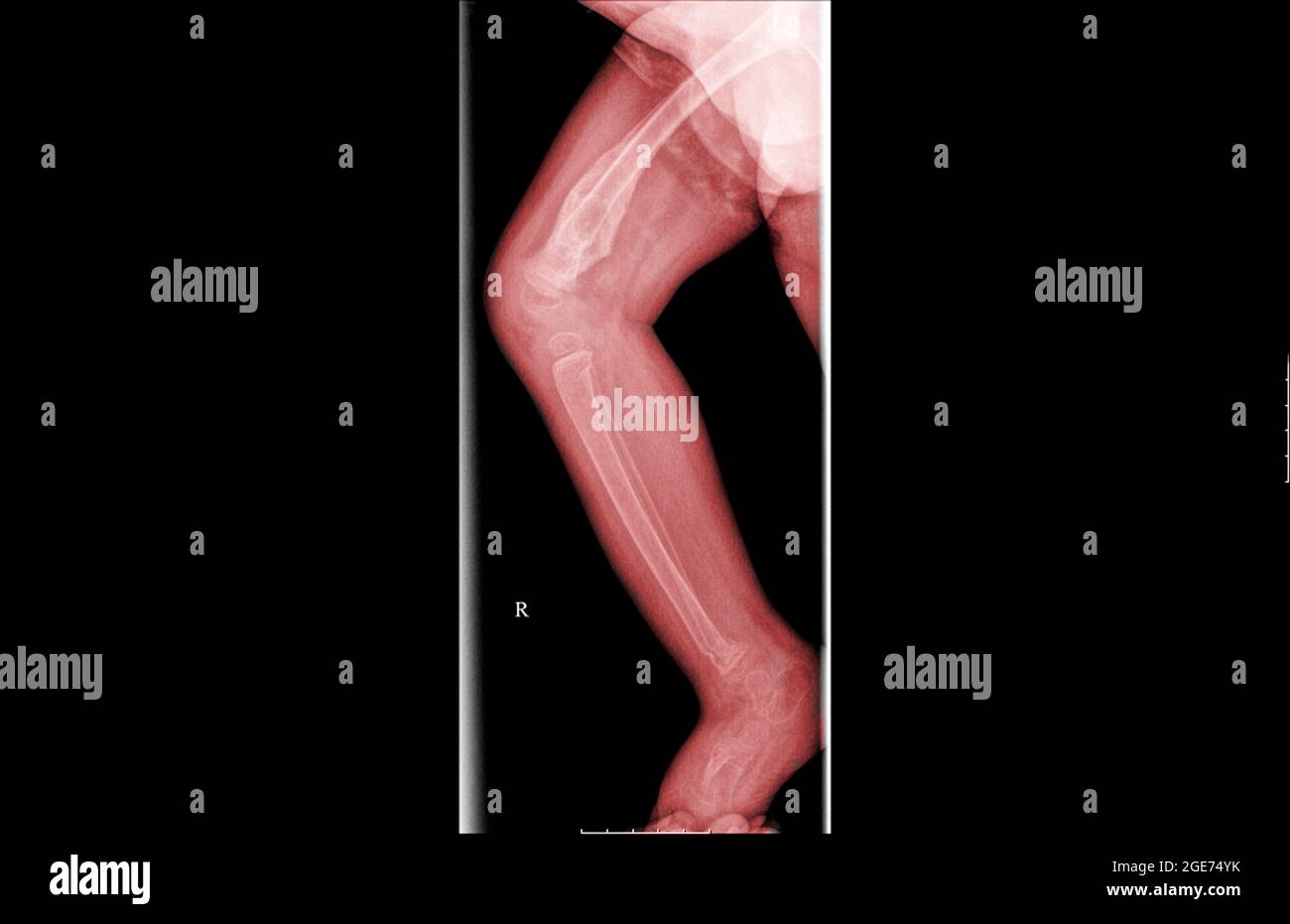 Radiographie d'un enfant de 3 ans avec un talon fracture du tibia et du péroné Banque D'Images