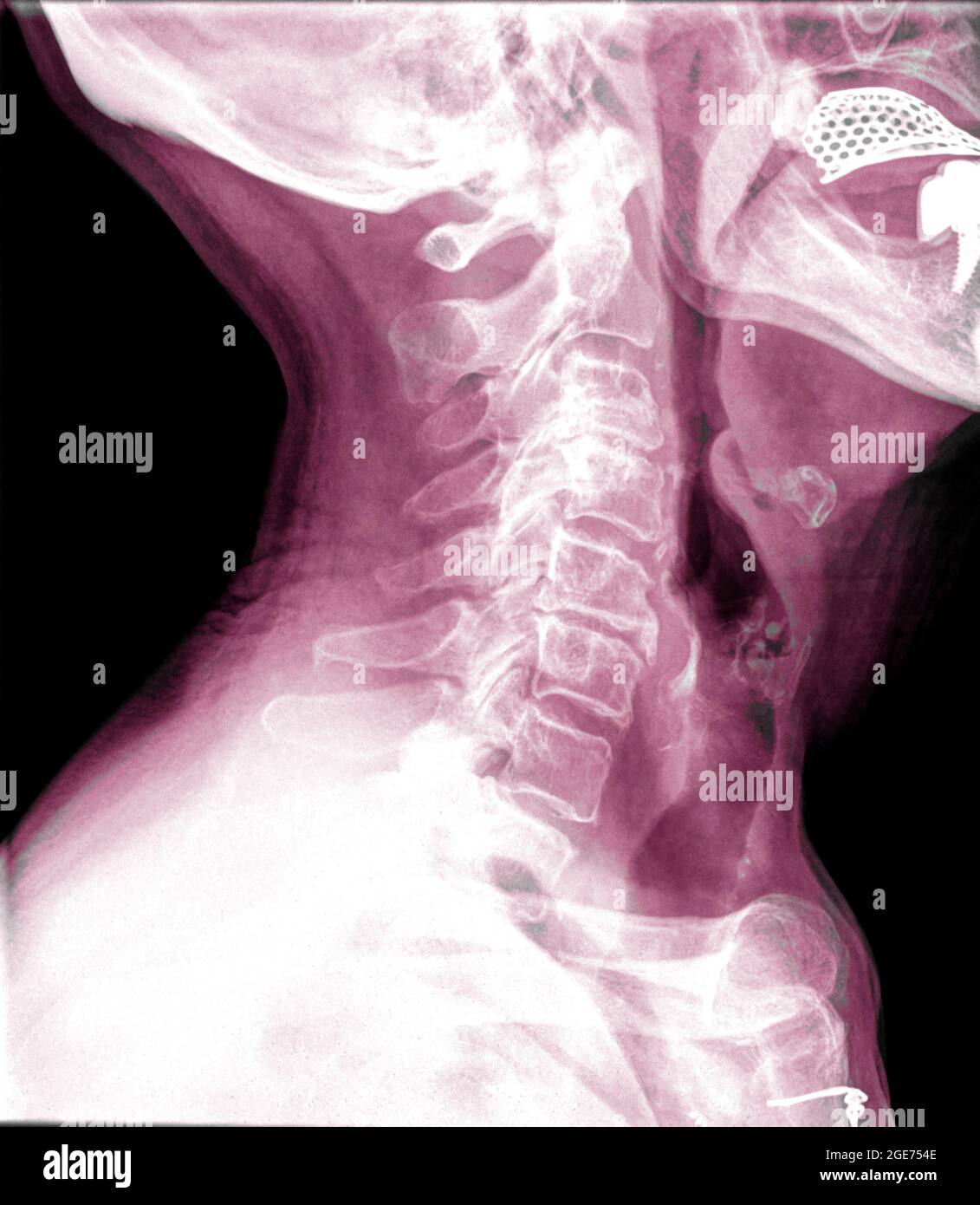 Vue latérale d'une patiente de 72 ans avec radiographie du rachis cervical Banque D'Images