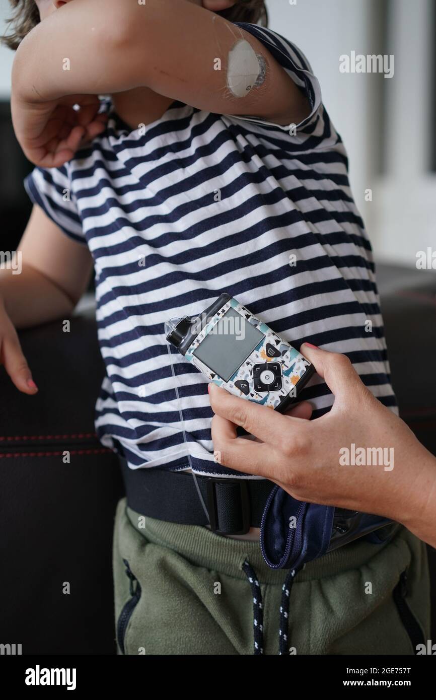 Berlin, Allemagne. 03ème août 2021. Oskar, quatre ans, montre une pompe à  insuline et un capteur sur son bras qui mesure sa glycémie. En Allemagne,  de plus en plus d'enfants et d'adolescents