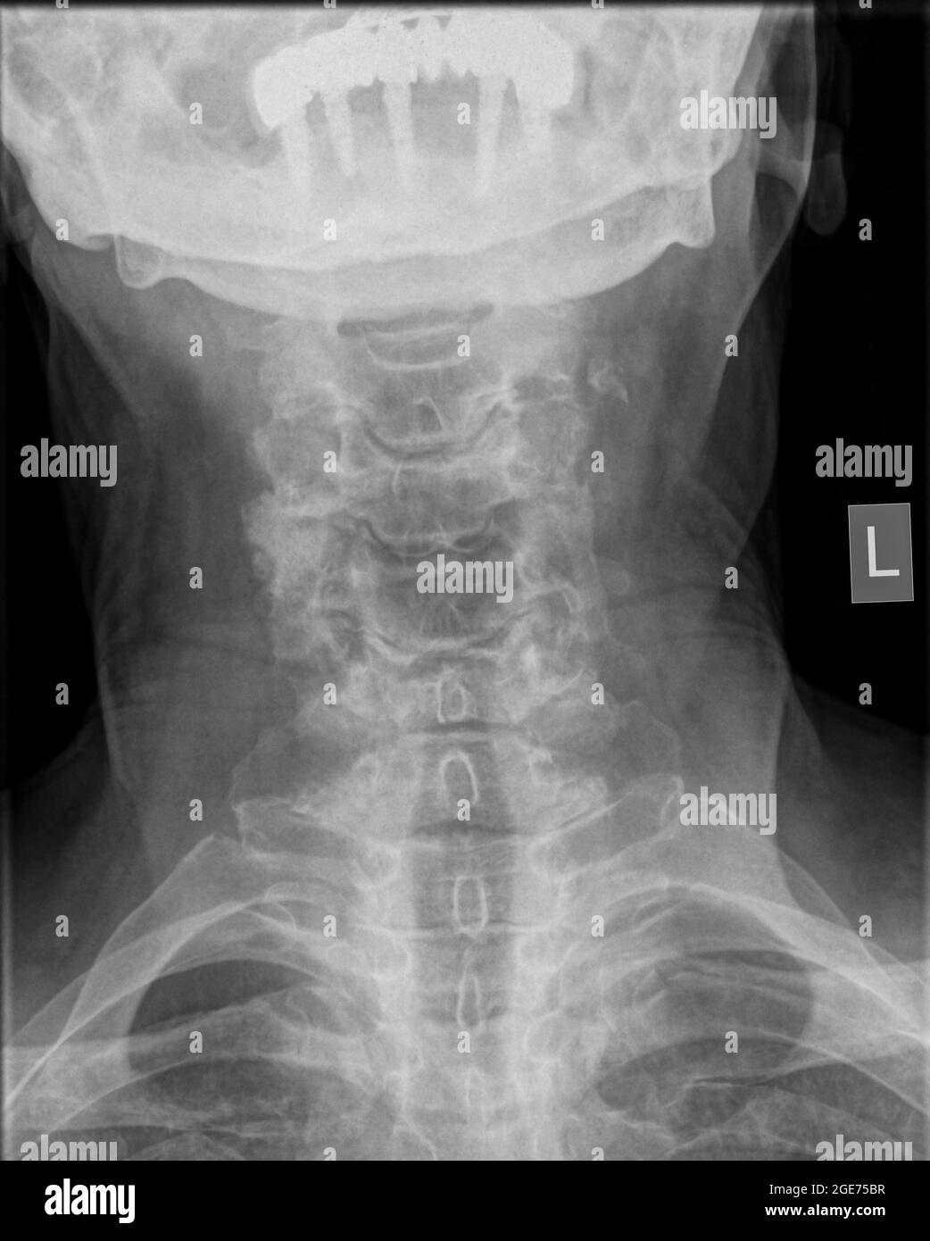Vue avant du rachis cervical d'une patiente de 72 ans Banque D'Images