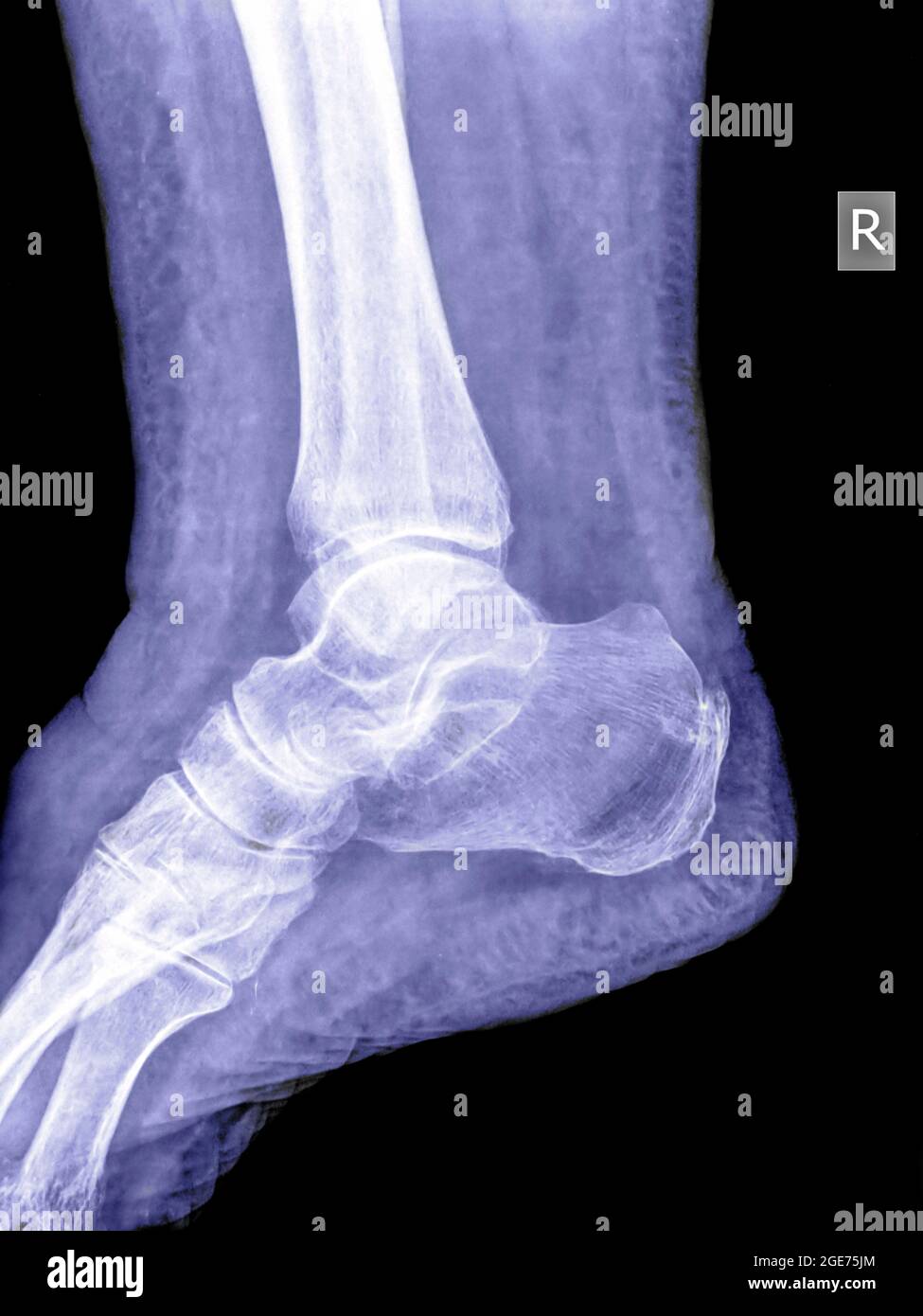 L'articulation de la cheville en bonne santé radiographie d'un patient de 79 ans. Pas de fracture ni entorse peut être vu Banque D'Images