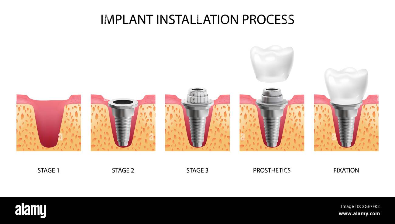 Cinq étapes de l'installation de l'implant dentaire illustration réaliste de vecteur isolé Illustration de Vecteur