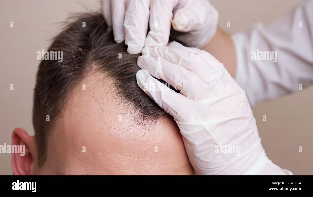 le travailleur médical en gants examine la tête d'un homme en balding de près Banque D'Images