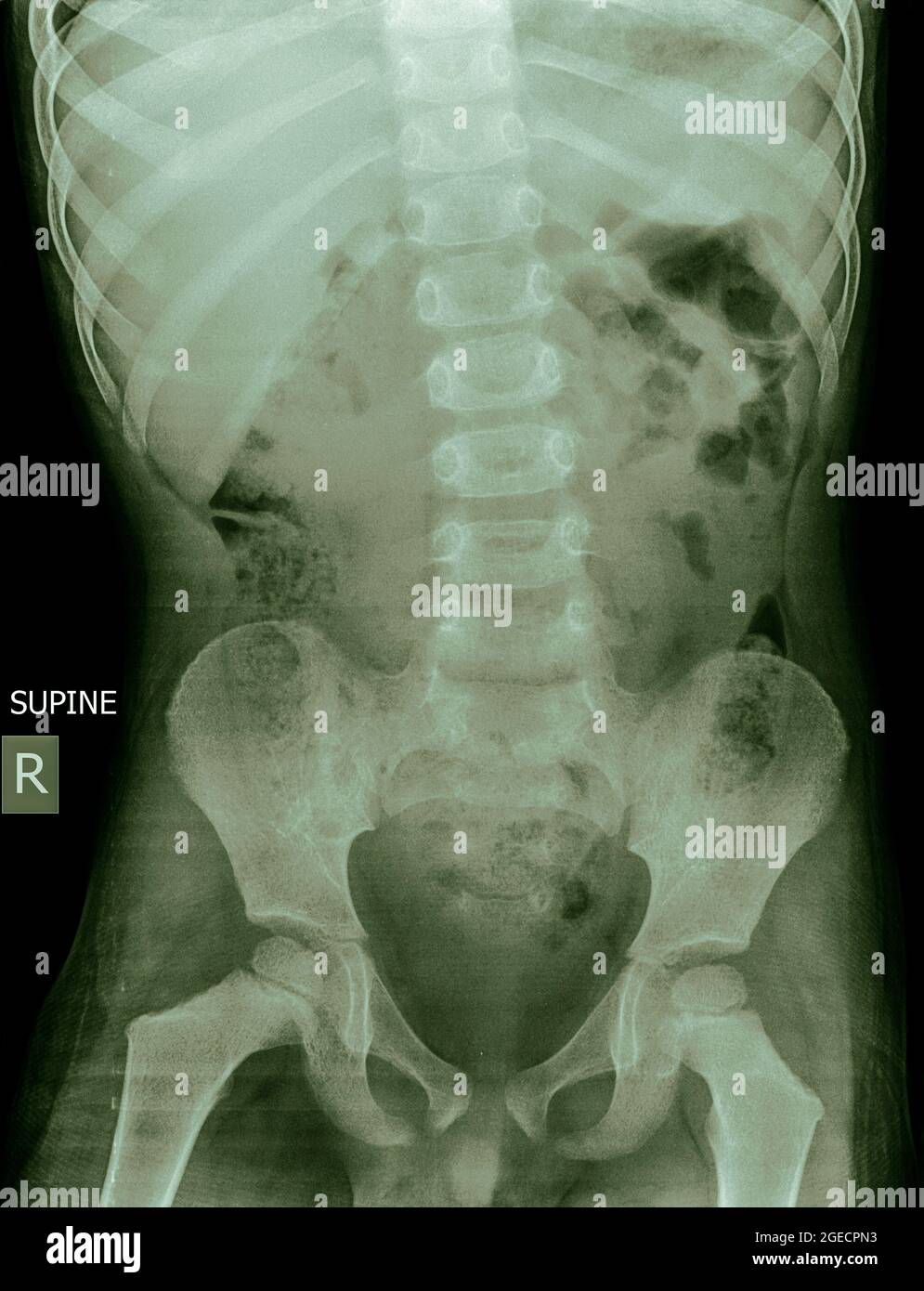 Radiographie abdominale d'un enfant de 5 ans allongé (position Décubitus dorsal) Banque D'Images