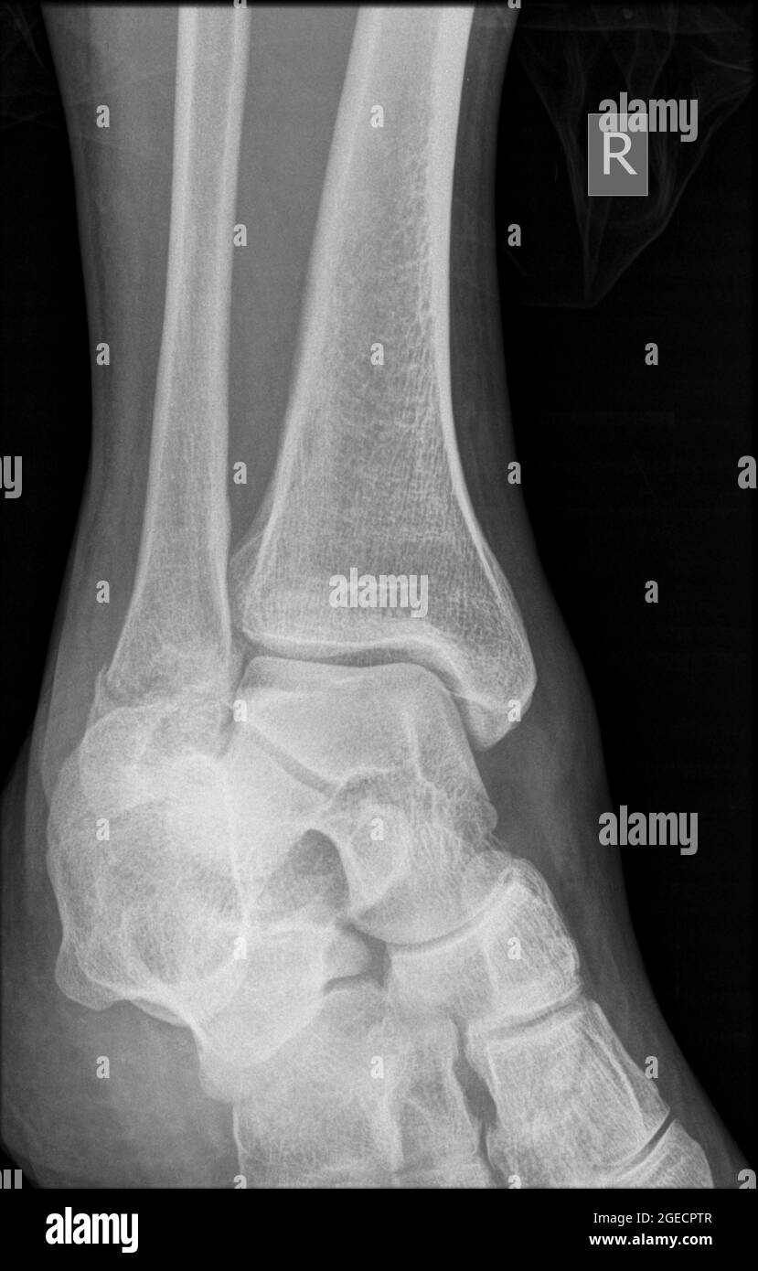 Rayons X d'un homme de 43 ans présentant une fracture dans le rayon distal Banque D'Images