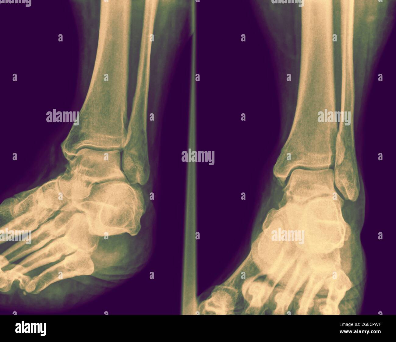 Radiographie d'un homme de 50 ans à la cheville avec un tibia distal fracturé. Vue avant Banque D'Images