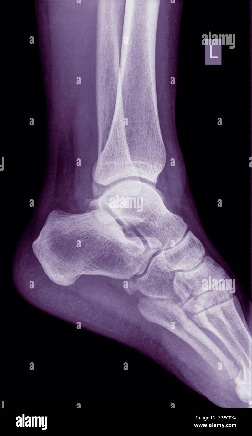 Radiographie d'une cheville d'une patiente de 53 ans présentant un Malleolus médian fracturé. Vue latérale Banque D'Images