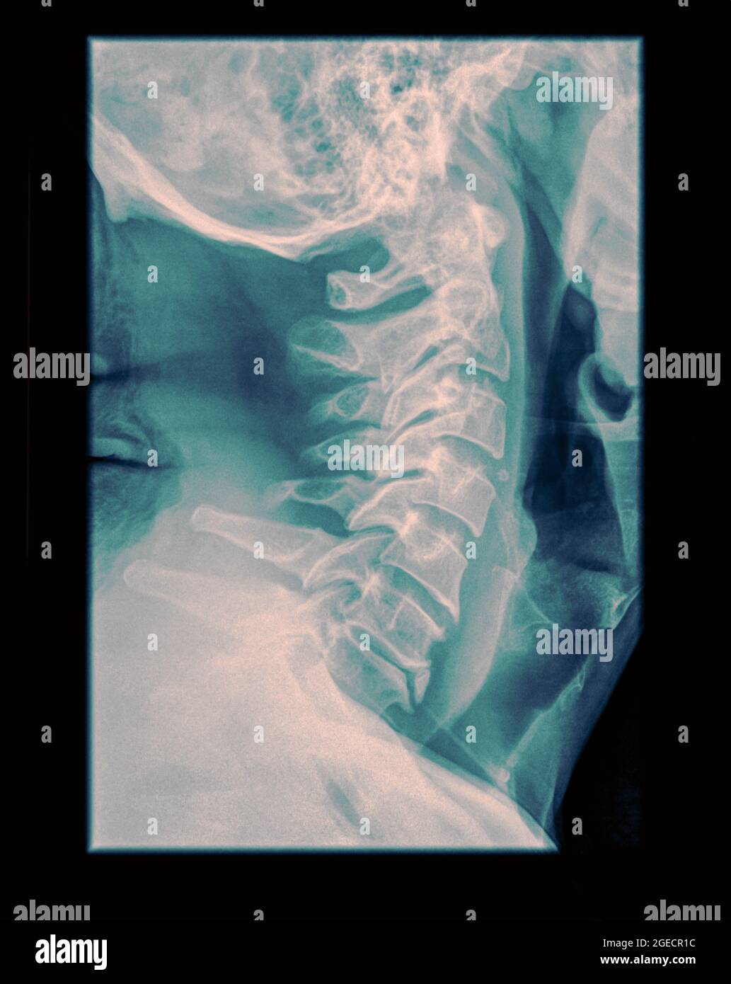 Colonne cervicale x-ray avec une fracture de la tanière. Un patient de sexe masculin âgé de 50 ans Vue latérale Banque D'Images