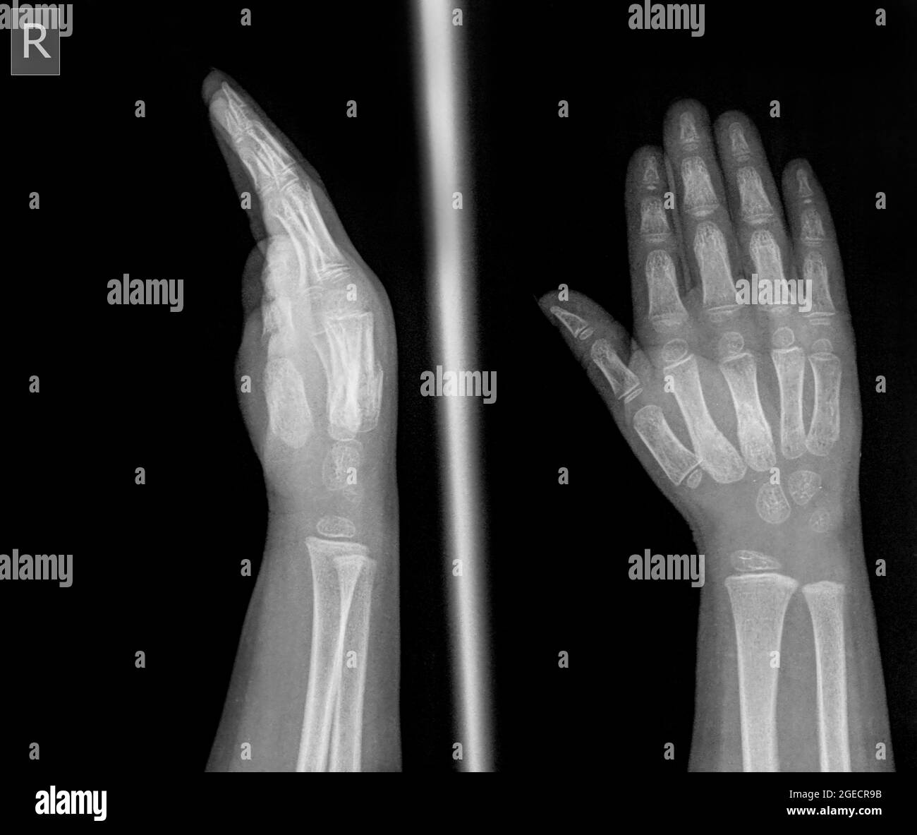 Radiographie d'un poignet fracturé Banque de photographies et d'images à  haute résolution - Alamy