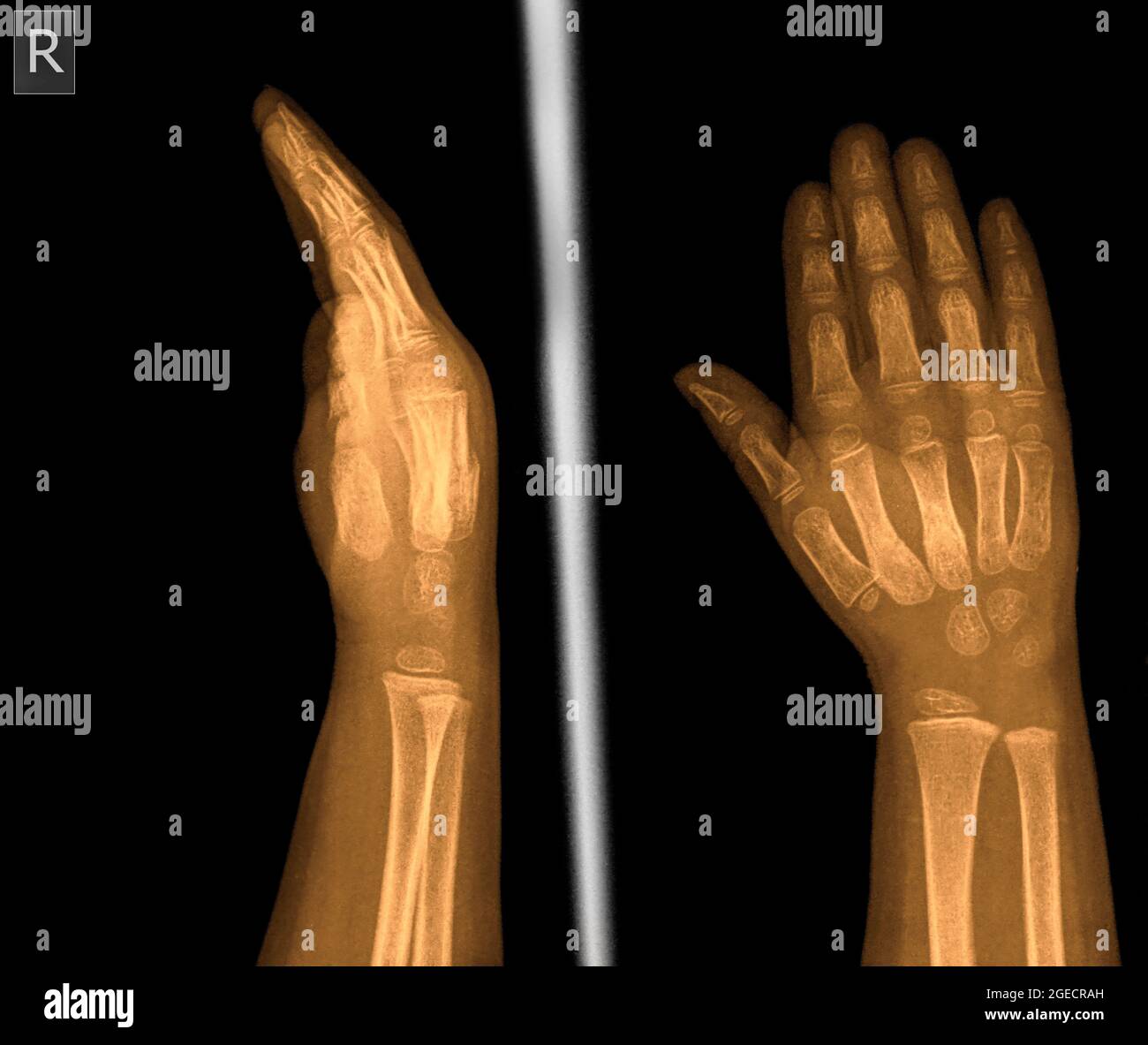 radiographie du poignet et de la main d'une patiente de 2 ans montrant 2 et 3 fractures métacarpiennes Banque D'Images