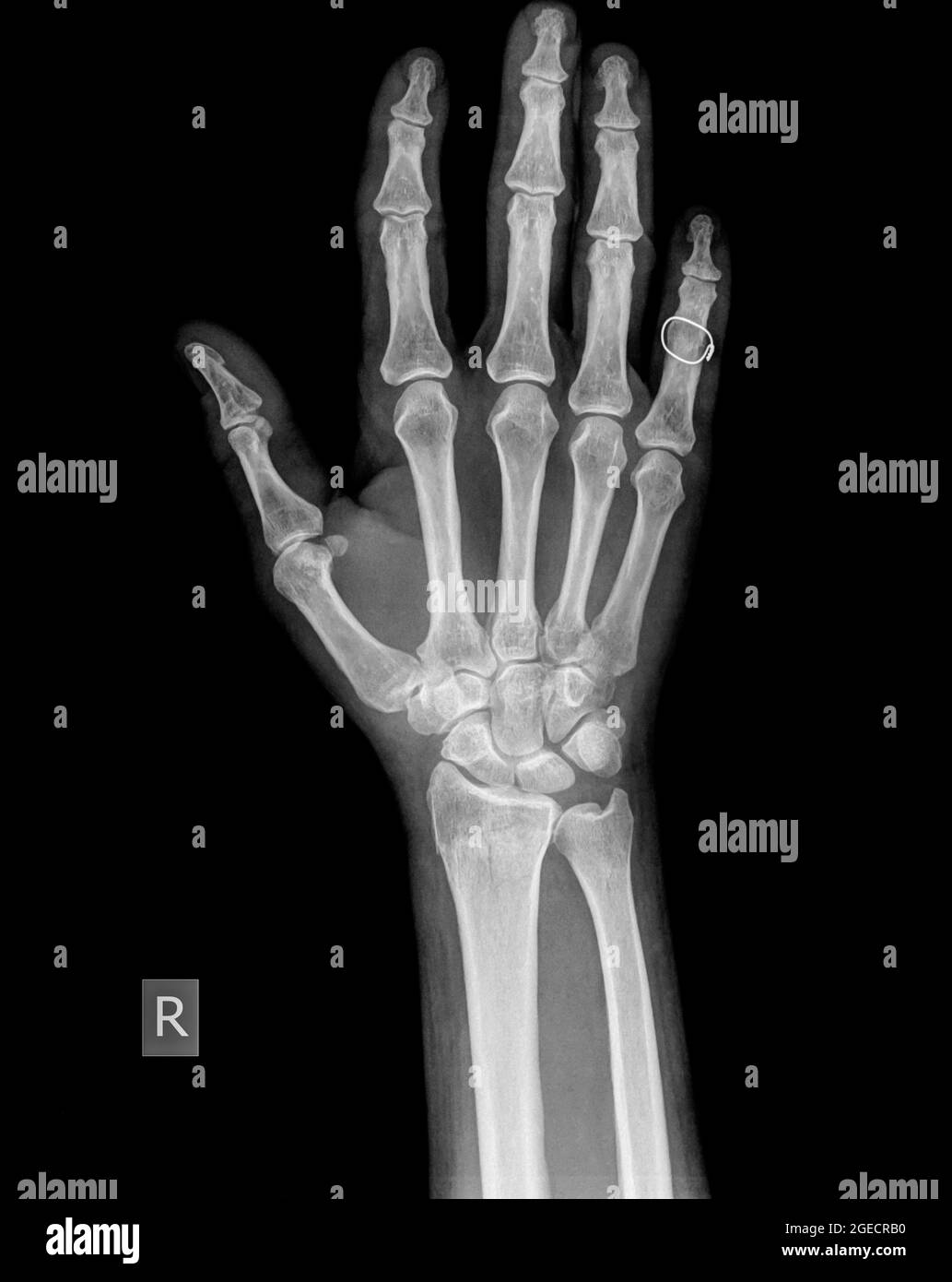 Rayons X du poignet, de la main et des doigts d'un homme de 64 ans présentant une fracture distale du rayon Banque D'Images