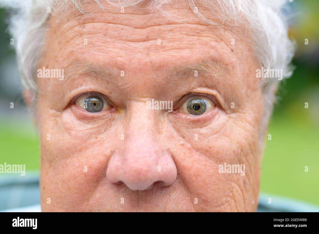 Homme âgé avec anisoria montrant une dilatation inégale de ses élèves en vue rapprochée sur ses yeux alors qu'il se fixe dans la lentille causée par la maladie, le traumatisme Banque D'Images