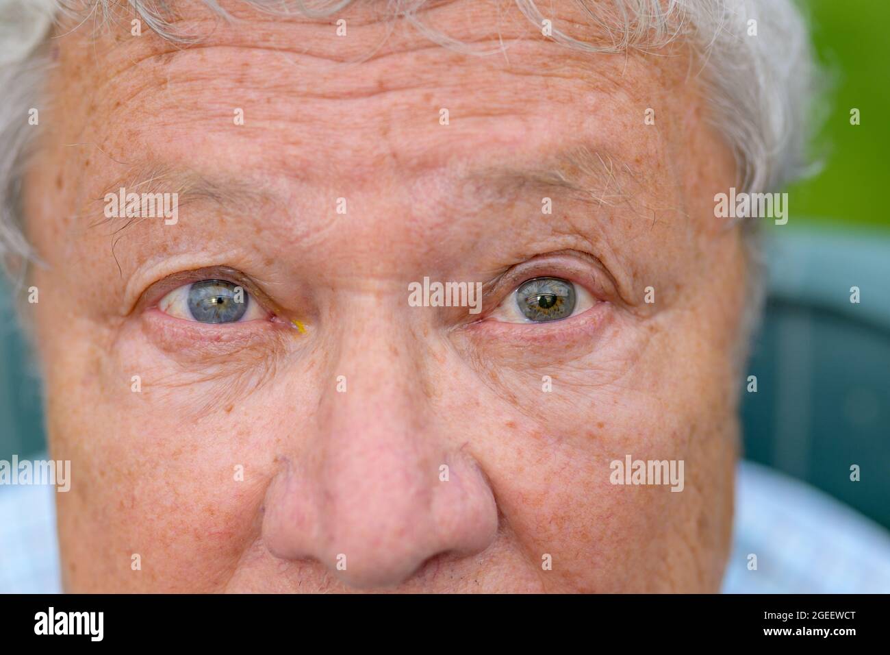 Yeux d'un homme âgé avec une maladie oculaire montrant une dilatation inégale de la pupille en gros comme il se fixe directement dans la lentille Banque D'Images