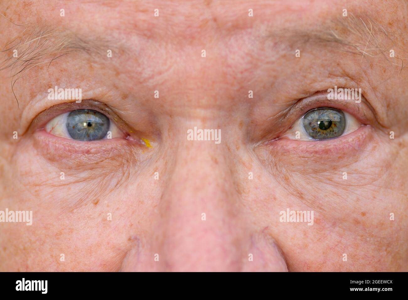 Gros plan extrême des yeux d'un homme âgé avec une maladie oculaire montrant une dilatation inégale de la pupille Banque D'Images