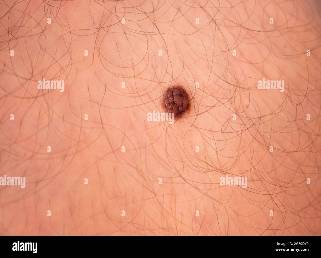 Gros plan photo de nevus. Prise de vue macro. Banque D'Images