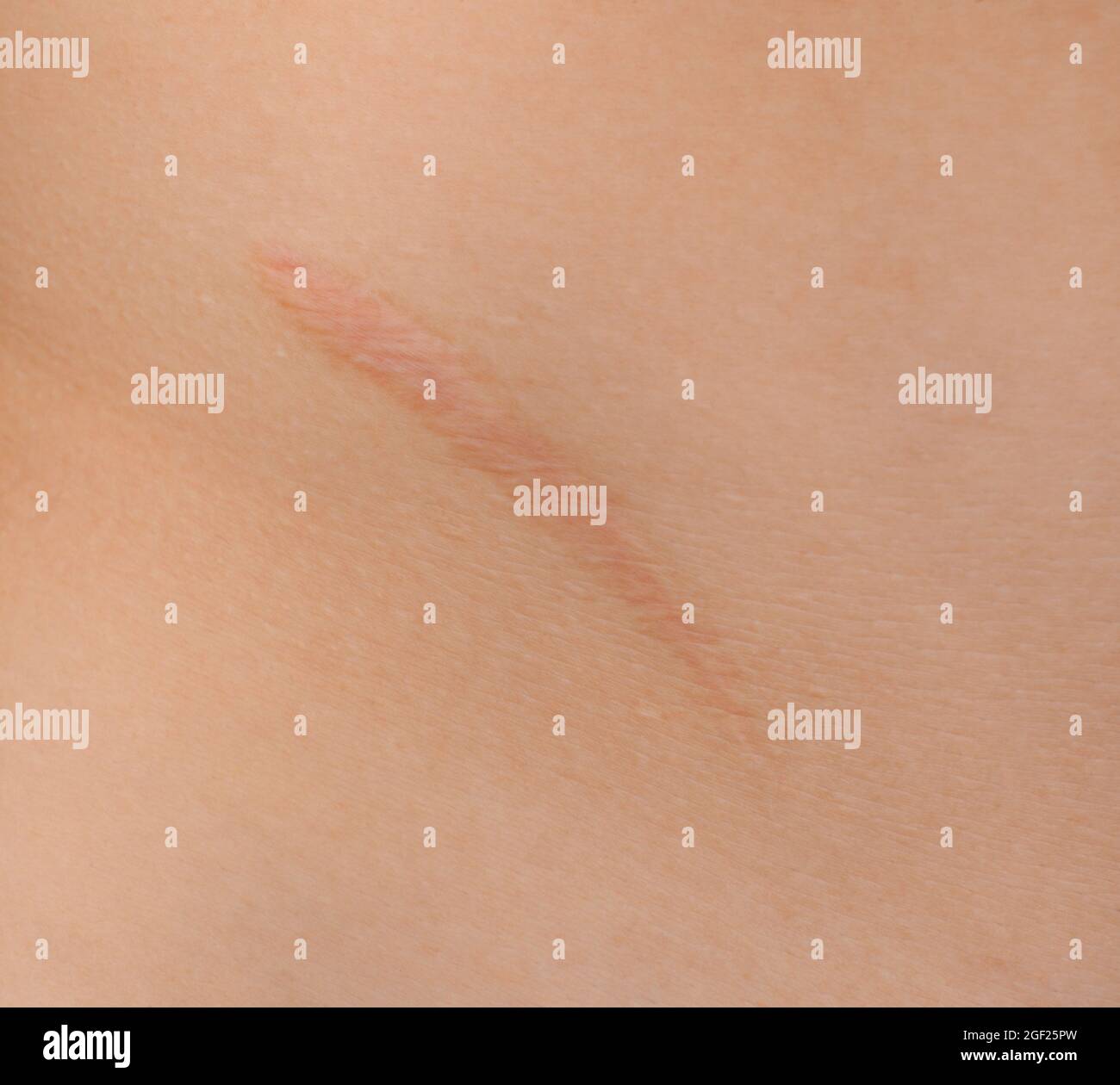 Cicatrice d'appendicite Banque de photographies et d'images à haute  résolution - Alamy