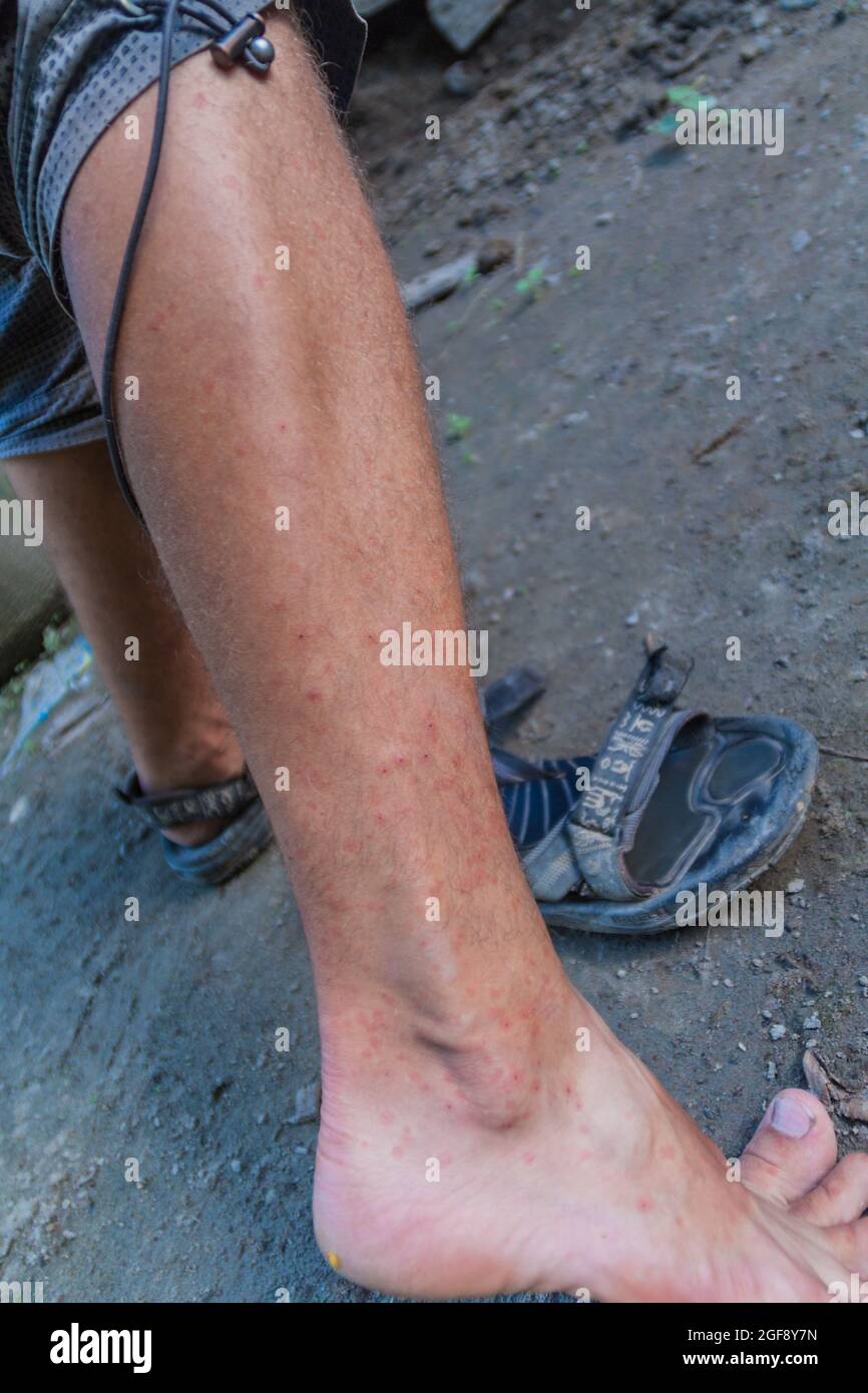 Jambe couverte par les piqûres de mouches des sables, jungle au Pérou Banque D'Images