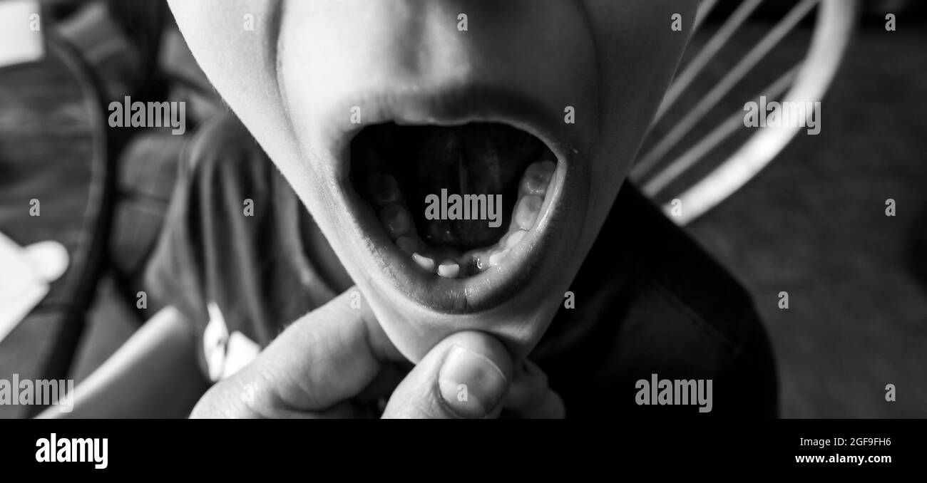 Fente Inferieure Avant Pour Bebes Ecartement Des Dents Montrant Les Gencives Et La Douille Photo Stock Alamy