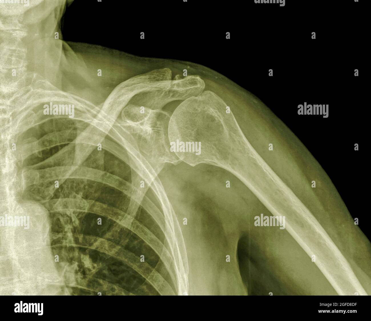 Radiographie de l'épaule Banque de photographies et d'images à haute  résolution - Alamy