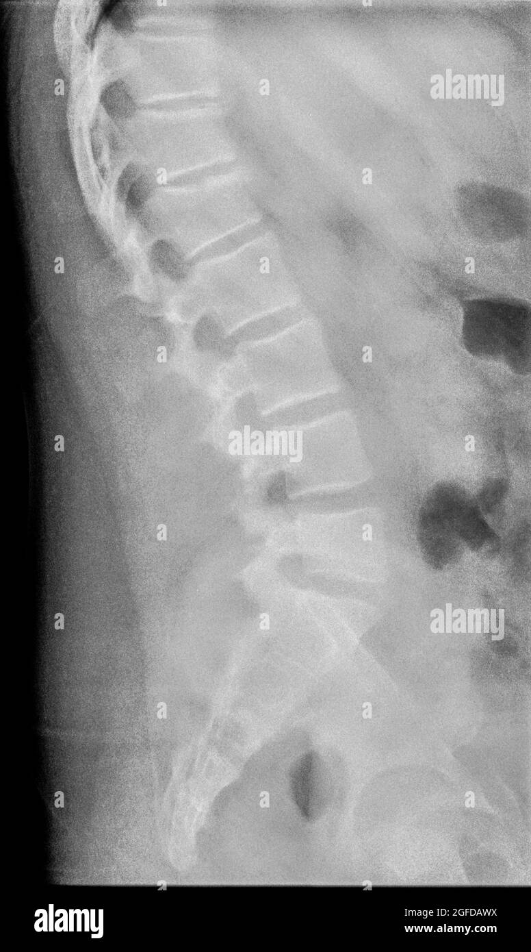 Radiographie du rachis lombaire humain d'un homme de 14 ans avec une fracture de compression de la vertèbre L2 vue latérale Banque D'Images