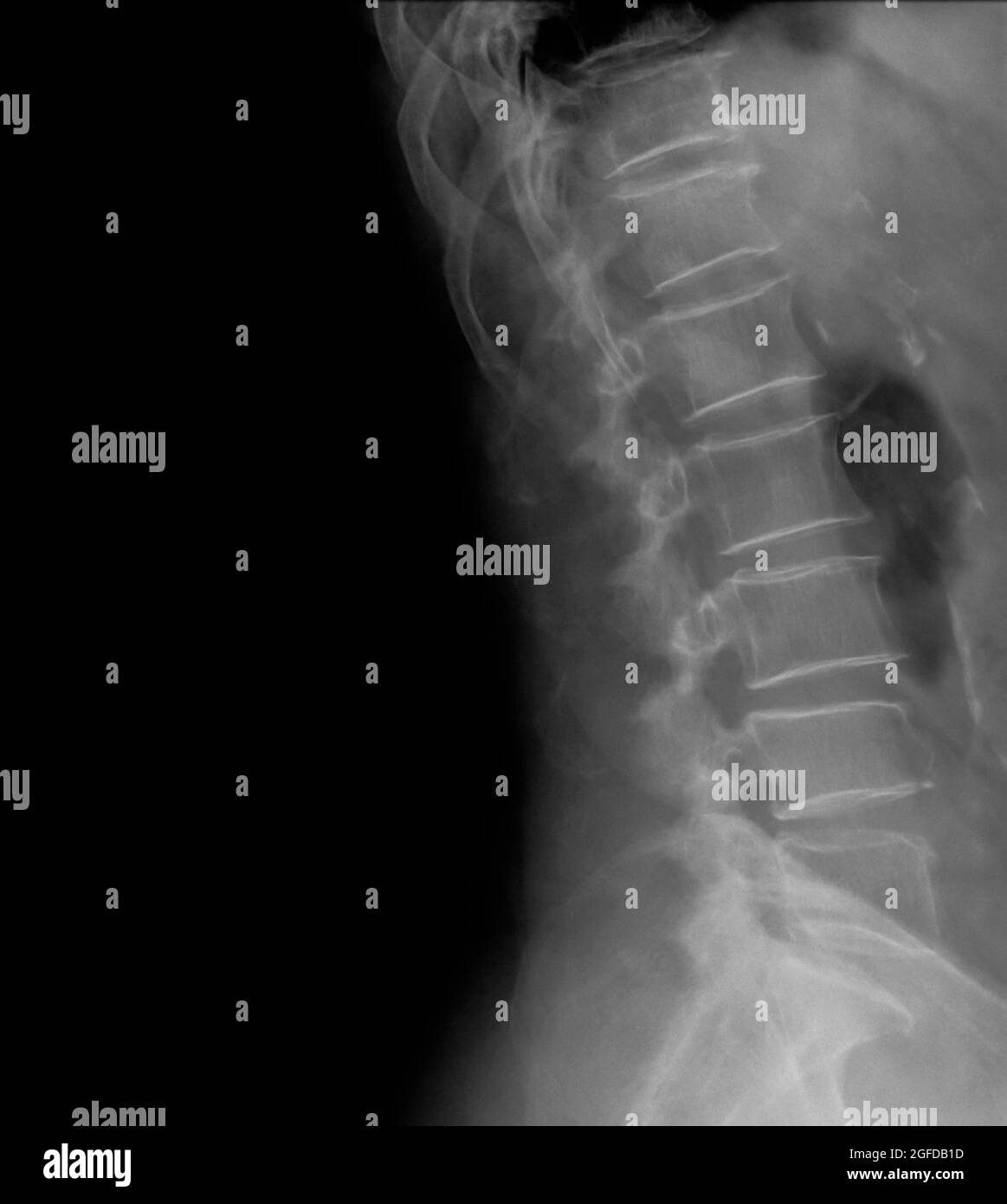 Rachis lombaire humain, vue latérale à rayons X, patient de 77 ans Banque D'Images
