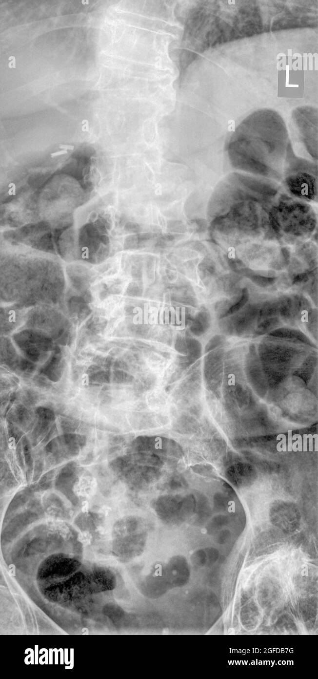 Douleurs dans le bas du dos. Rachis lombaire humain vue avant à rayons X femelle de 75 ans Banque D'Images