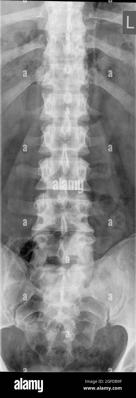Vue avant à rayons X du rachis lombaire humain Banque D'Images