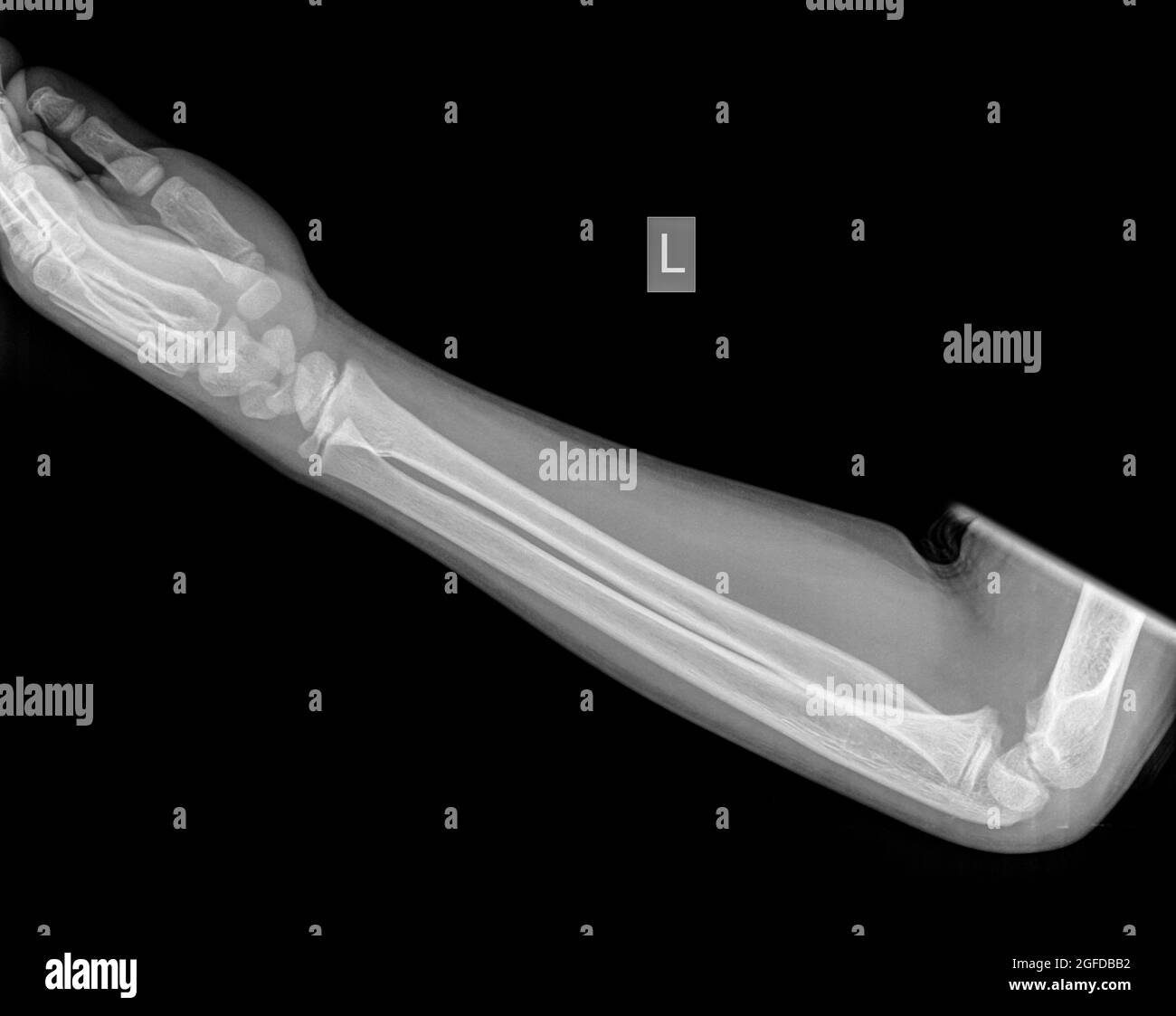 Avant-bras d'un patient de sexe masculin de 9 ans avec une Fracture du radius distal Banque D'Images