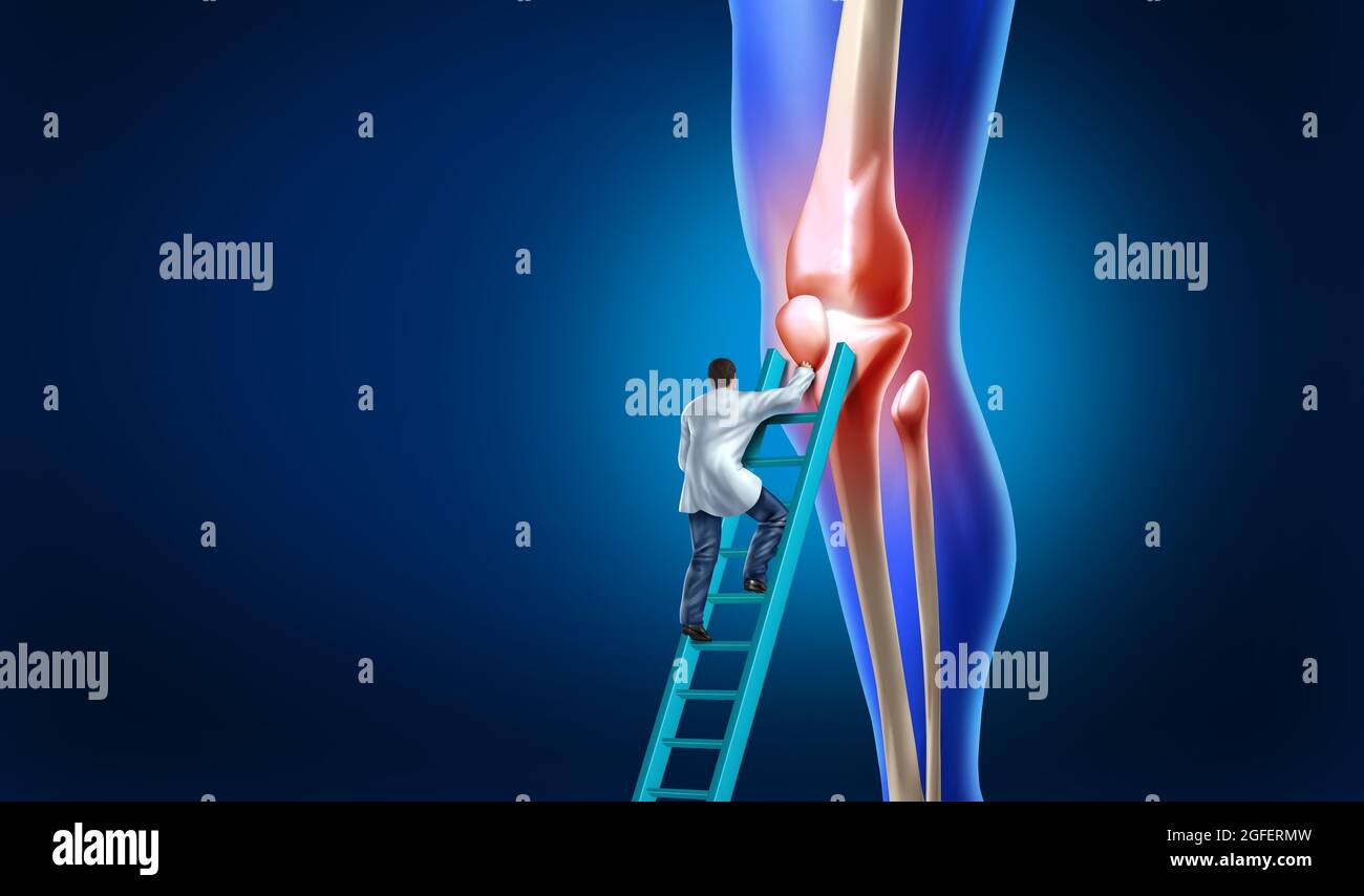 La douleur du genou s'occupe de l'anatomie d'une jambe squelette et montre l'inflammation interne comme une articulation douloureuse qui nécessite une intervention chirurgicale par un chirurgien orthopédique. Banque D'Images