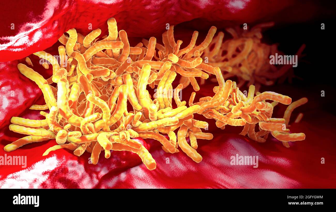 Accumulation de bactéries tuberculeuses dans le tube pulmonaire - illustration 3d Banque D'Images