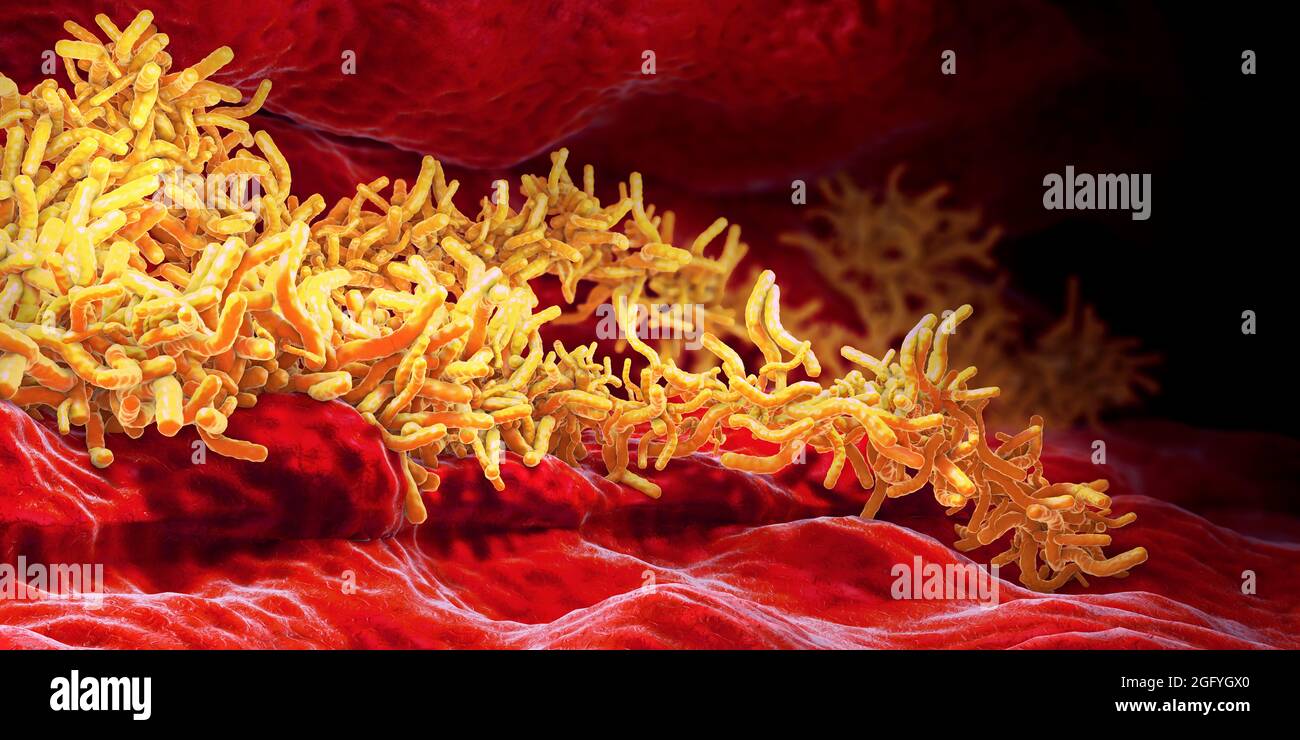 Accumulation de bactéries tuberculeuses dans le tube pulmonaire - illustration 3d Banque D'Images