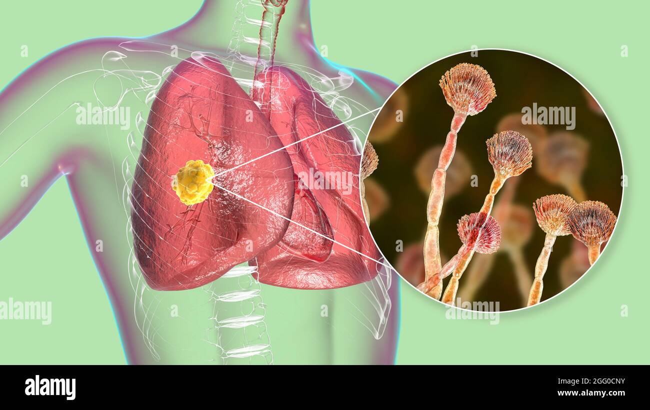 Illustration d'une aspergillose pulmonaire, invasion d'un tissu pulmonaire par des champignons de moisissure Aspergillus avec vue rapprochée des champignons. Banque D'Images