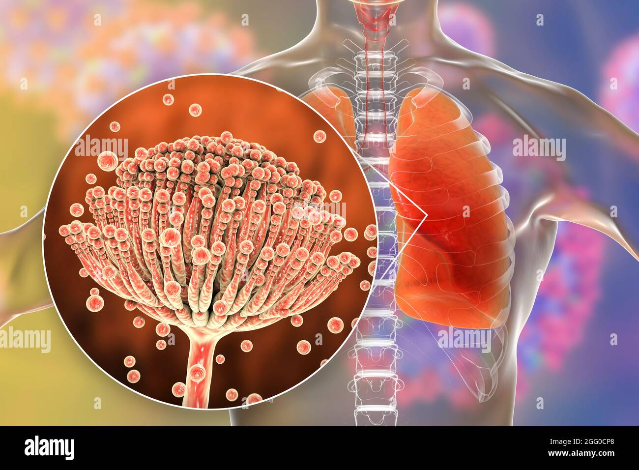 Illustration d'une aspergillose pulmonaire, invasion d'un tissu pulmonaire par des champignons de moisissure Aspergillus avec vue rapprochée des champignons. Banque D'Images