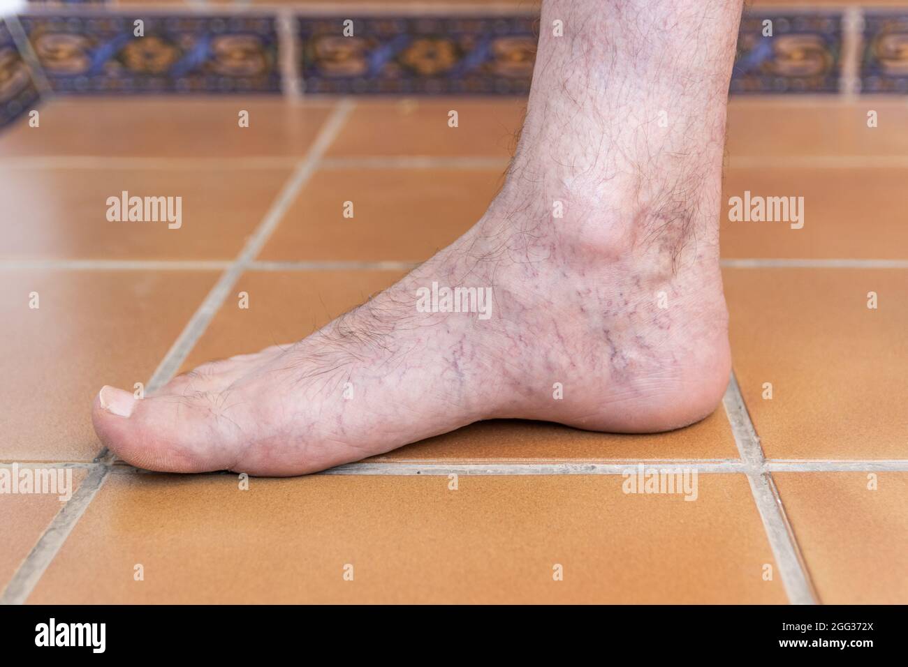 Pied d'homme adulte avec varices Banque D'Images