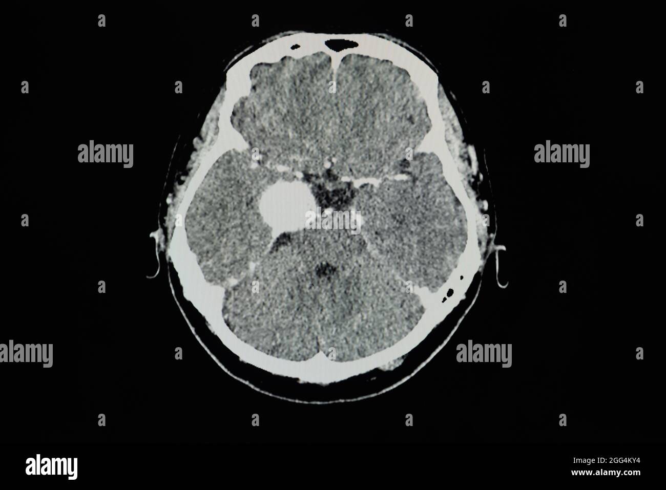 TDM cérébrale avec contraste d'un patient présentant une lésion rehaussant le bord de 3.8 cm au niveau du sinus caverneux droit avec calcification interne, le plus probable ménigiome Banque D'Images