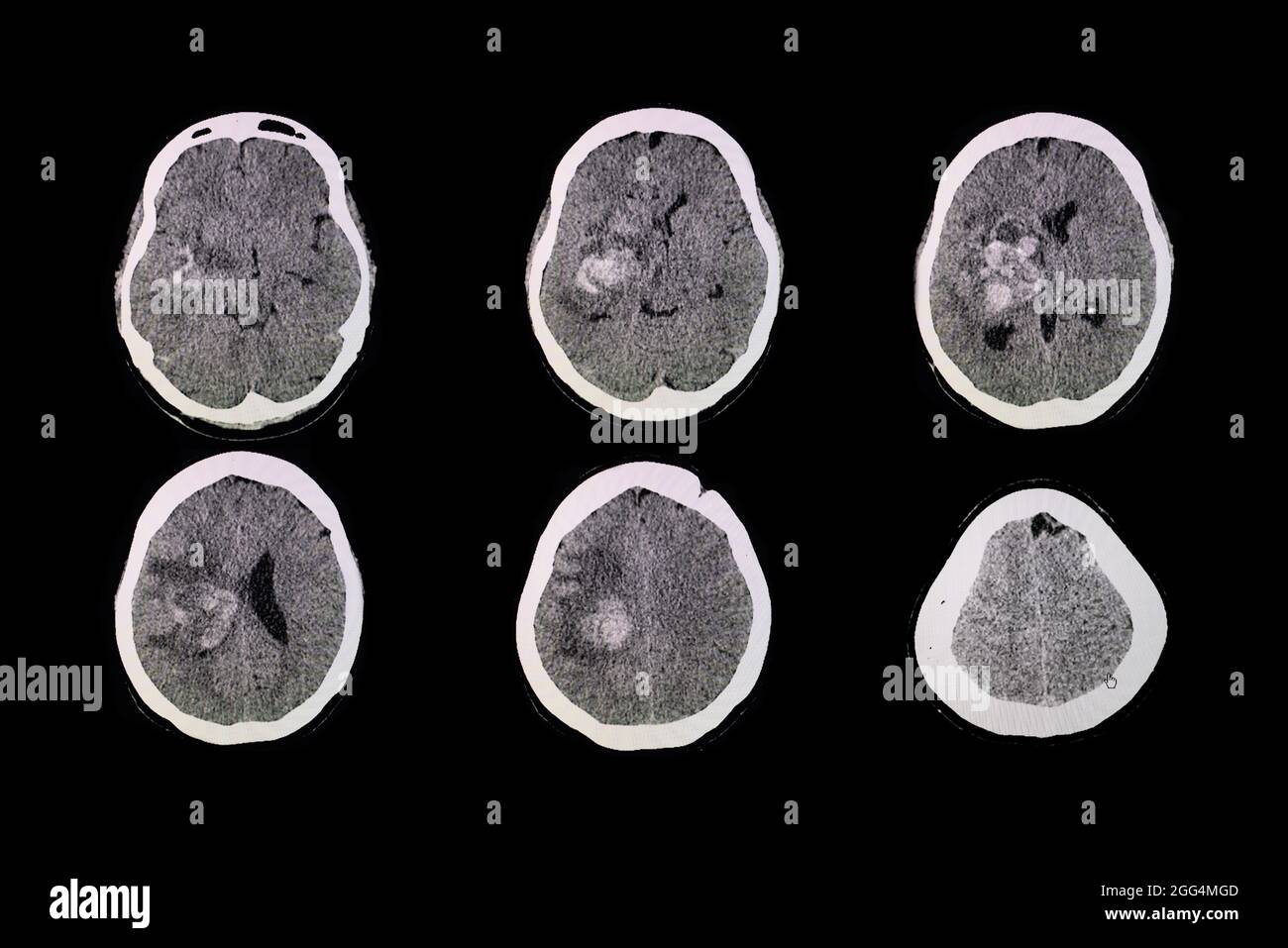Scanner du cerveau du patient avec une hémorragie et un hématome au niveau de la ganglion basal droit. Banque D'Images