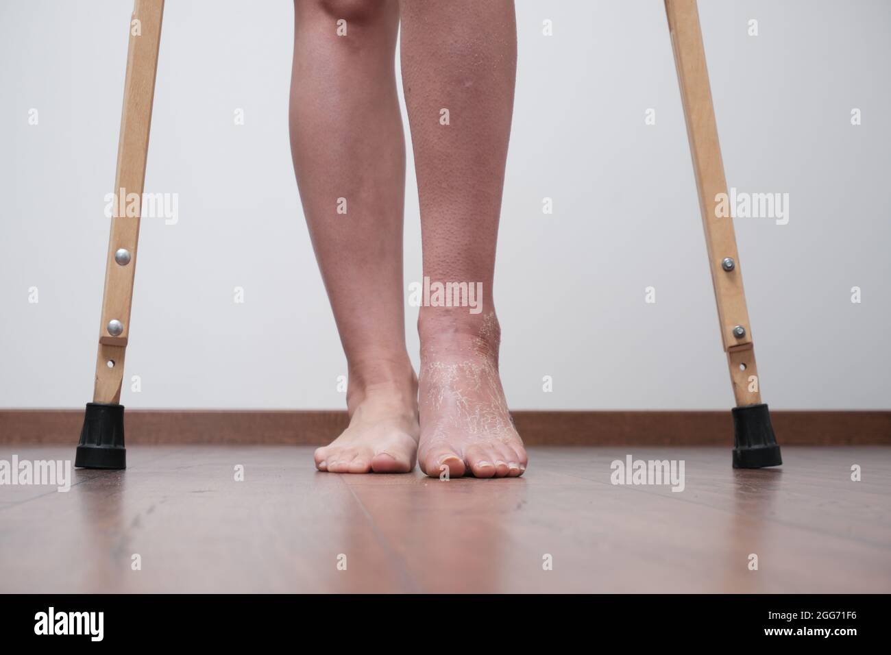 Une femme après une jambe cassée pour apprendre à marcher. Réhabilitation après retrait du pansement. Une femme marche sur des béquilles. Banque D'Images