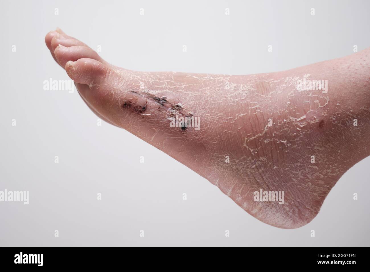 Suture postopératoire sur le pied, la jambe après la fracture et après l'enlèvement du pansement. Banque D'Images