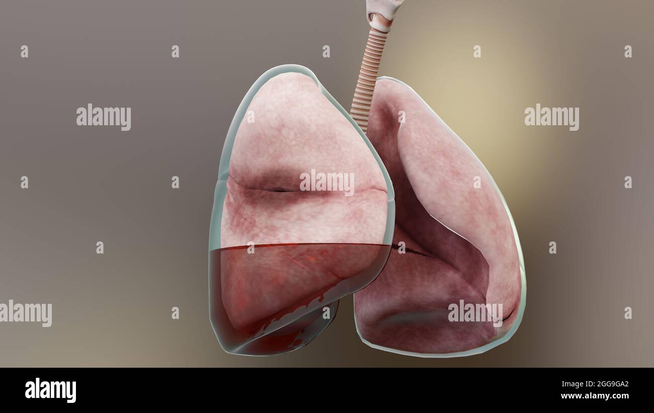 illustration 3d de l'hémopneumothorax, poumon normal versus collapsus, symptômes de l'hémopneumothorax, épanchement pleural, empyema, complications Banque D'Images