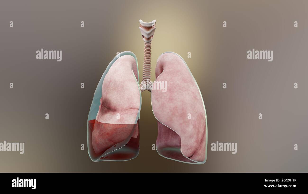 illustration 3d de l'hémopneumothorax, poumon normal versus collapsus, symptômes de l'hémopneumothorax, épanchement pleural, empyema, complications Banque D'Images