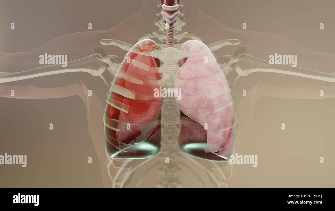 illustration 3d de l'hémothorax, poumon normal versus collapsus, symptômes de l'hémothorax, épanchement pleural, empyème, complications après une blessure à la poitrine, Banque D'Images