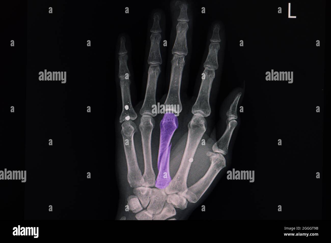 Film radiographique de fracture en spirale du troisième os métacarpien avec 3 artefacts métalliques. Banque D'Images