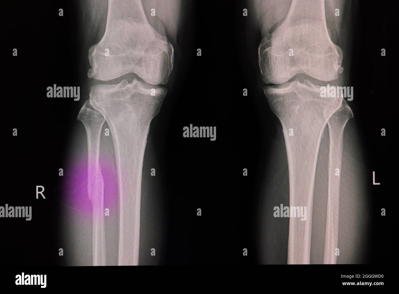 Film radiographique d'un genou d'un patient présentant un péroné proximal fracturé. Fracture osseuse de la jambe. Banque D'Images
