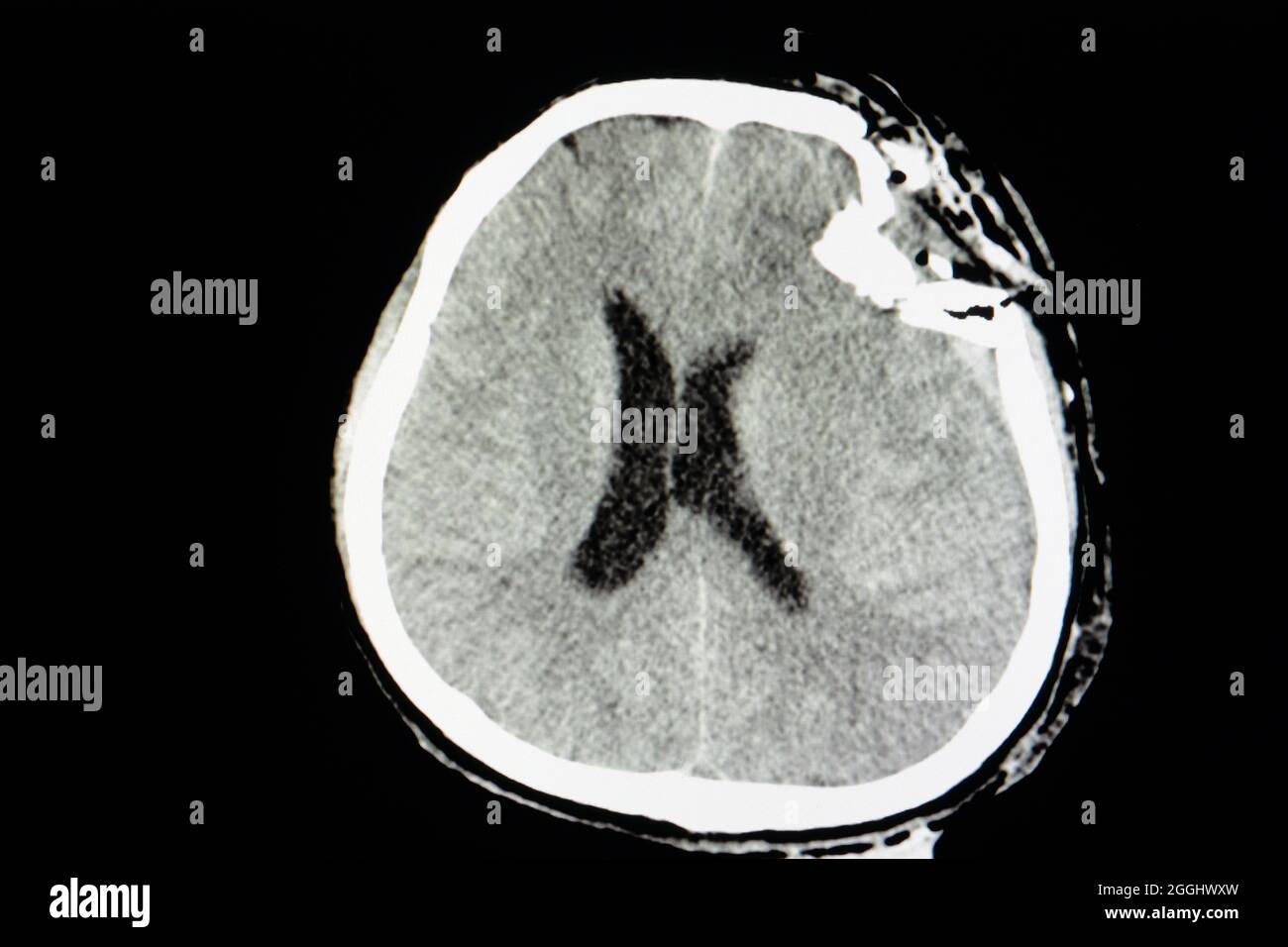 Film TDM du crâne d'un patient présentant une lésion cérébrale traumatique montrant une fracture de compression de l'os du tempérament gauche. Banque D'Images