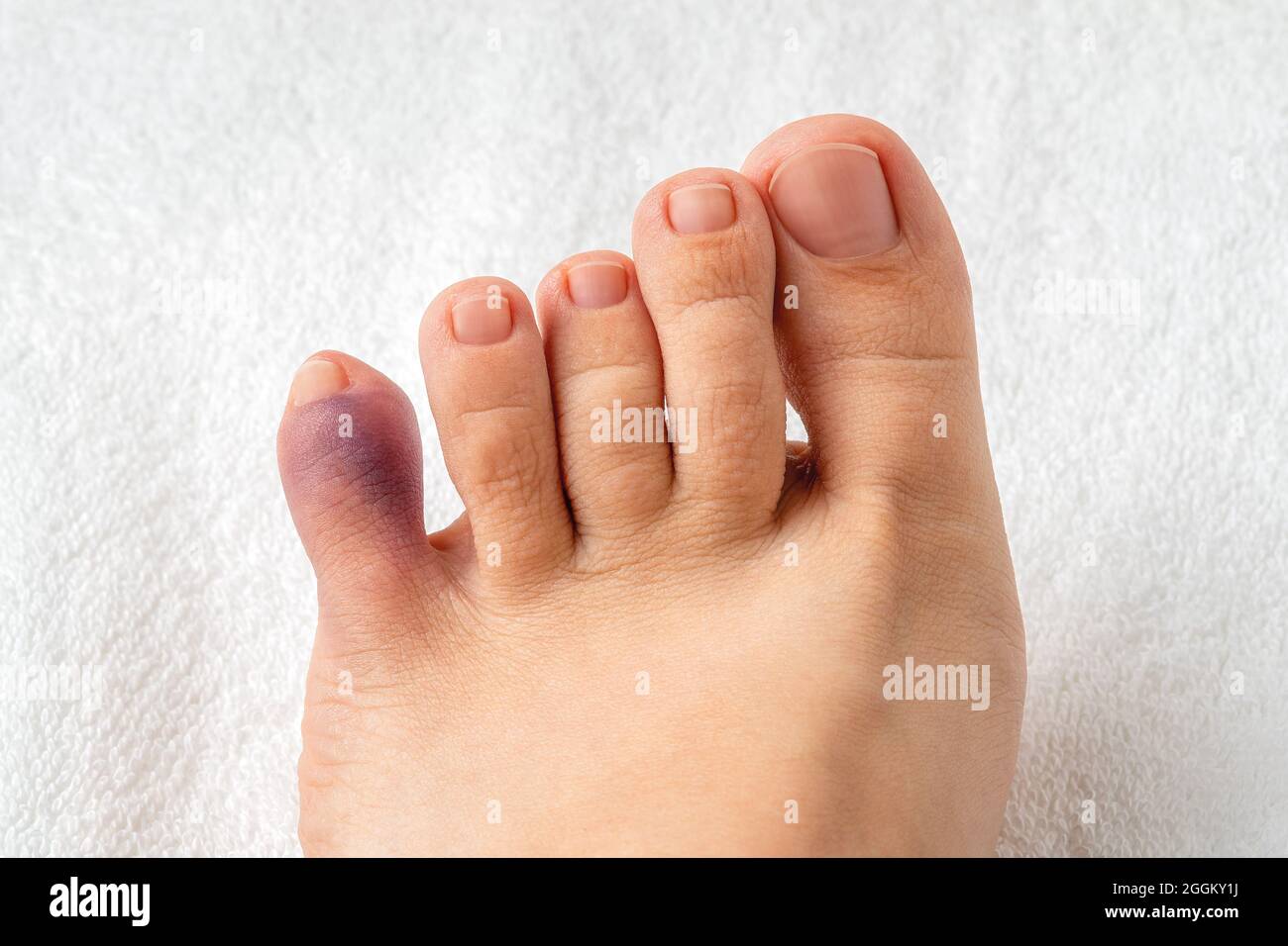 Ecchymose pourpre sur le petit orteil du pied de la femme. Blessure du pied  petit doigt après un accident à la maison. Pointe pinky cassée, fracture de  la phalange. Vue de dessus